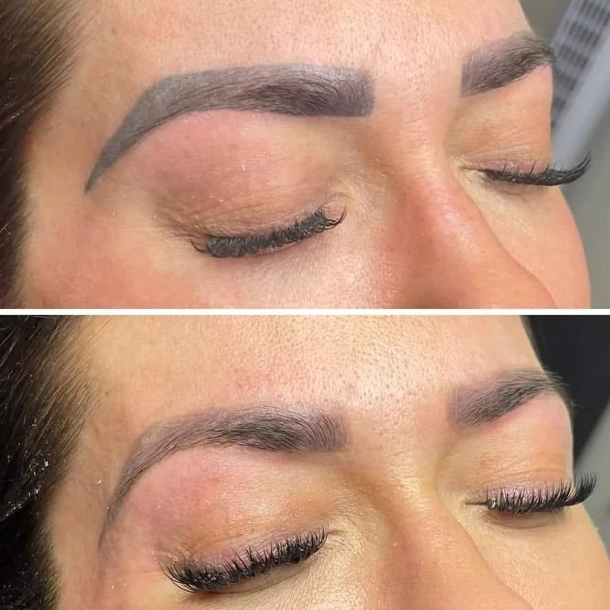 Laser+Brow+removal (1)