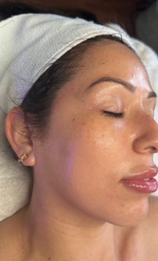 After Image: HydraFacial - right-front-oblique