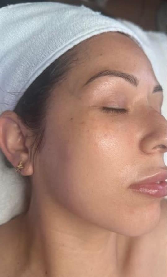 Before Image: HydraFacial - right-front-oblique