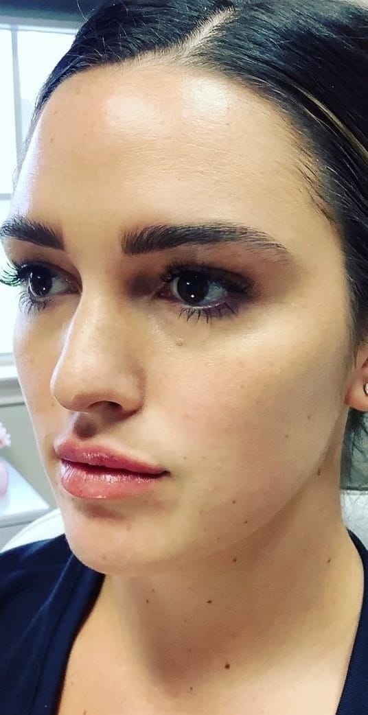 After Image: Lip Filler - left-front-oblique