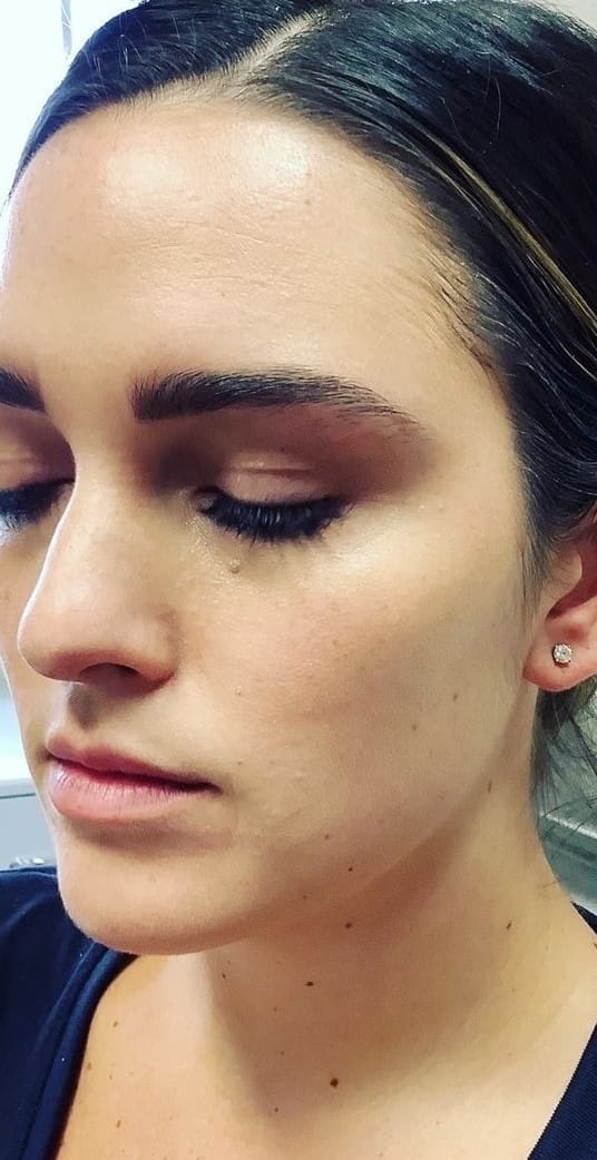 Before Image: Lip Filler - left-front-oblique