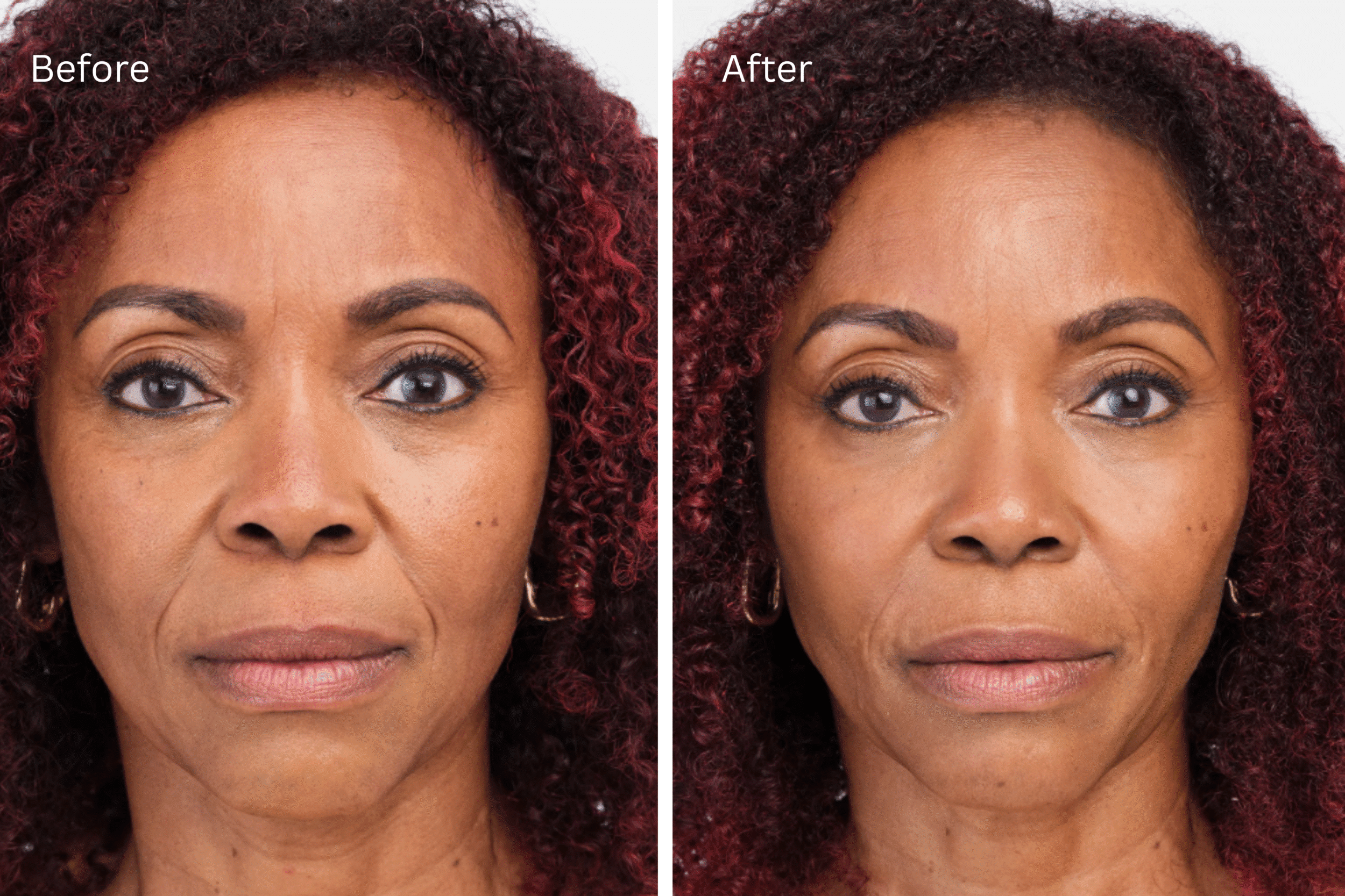 Facial restoration with Radiesse