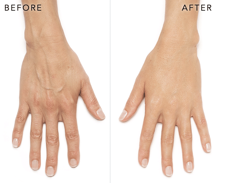 Radiesse hand transformation