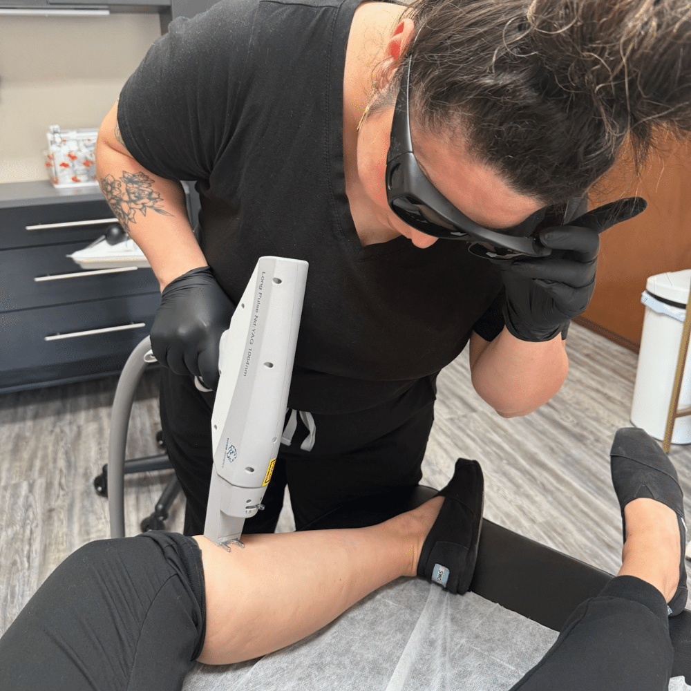 Laser removal of spider veins